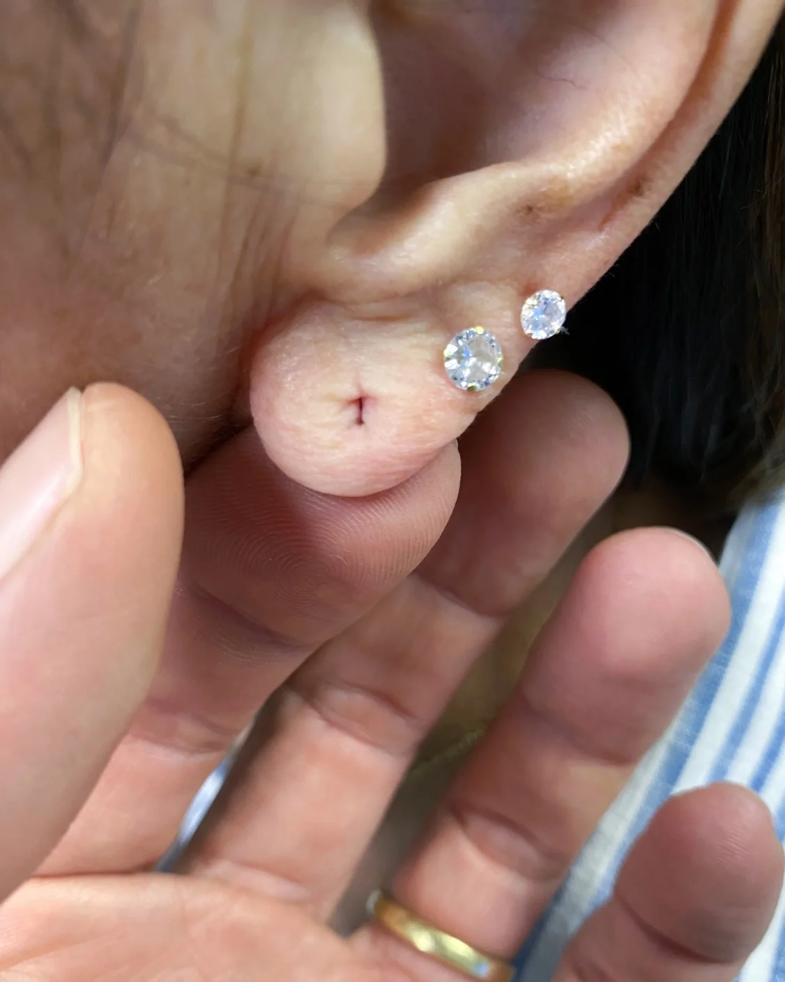 Correção de Lóbulo de Orelha